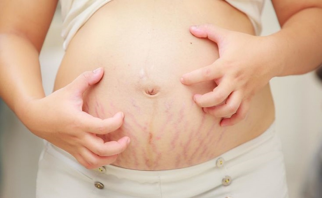 Bí kíp để mẹ bầu tự tin về làn da